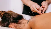 A practitioner appears to be performing acupuncture on a patient's back, inserting fine needles into specific points.